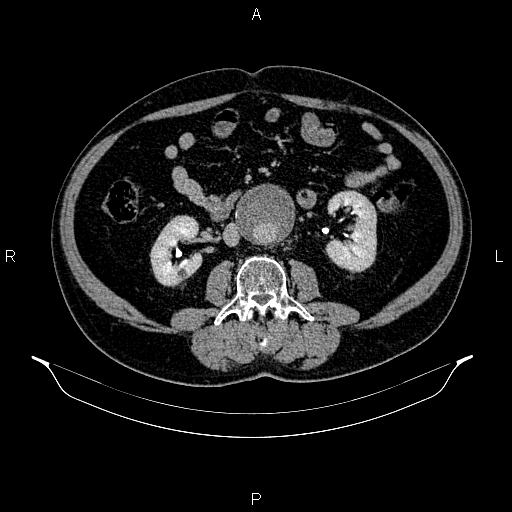 Abdominal aortic aneurysm (Radiopaedia 83094-97462 Axial renal excretory phase 54).jpg