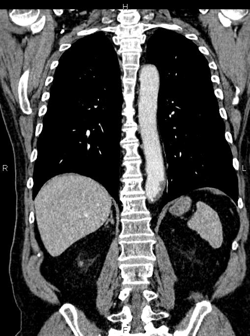 Abdominal aortic aneurysm (Radiopaedia 83094-97462 Coronal renal cortical phase 64).jpg