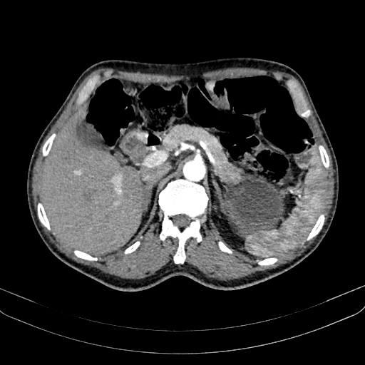 Abdominal aortic aneurysm (Radiopaedia 83581-98689 Axial C+ arterial phase 37).jpg