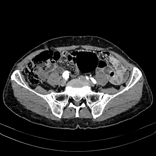 File:Abdominal aortic aneurysm (Radiopaedia 83581-98689 Axial C+ arterial phase 84).jpg