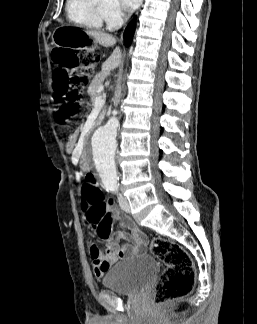 Abdominal aortic aneurysm (Radiopaedia 83581-98689 Sagittal C+ portal venous phase 49).jpg