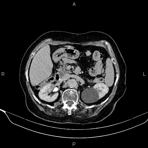 File:Abdominal aortic aneurysm (Radiopaedia 85063-100606 Axial C+ delayed 33).jpg