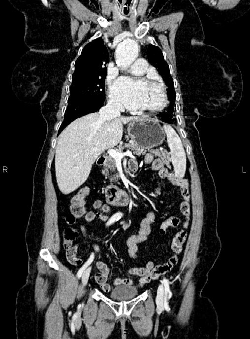 Abdominal aortic aneurysm (Radiopaedia 85063-100606 Coronal C+ arterial phase 19).jpg