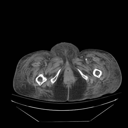 Abdominal aortic aneurysm - impending rupture (Radiopaedia 19233-19247 Axial non-contrast 179).jpg