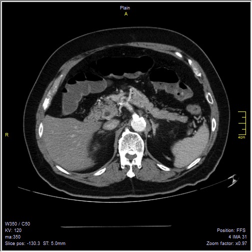 Abdominal aortic aneurysm with thrombus fissuration (Radiopaedia 47340-51926 Axial C+ arterial phase 15).jpg