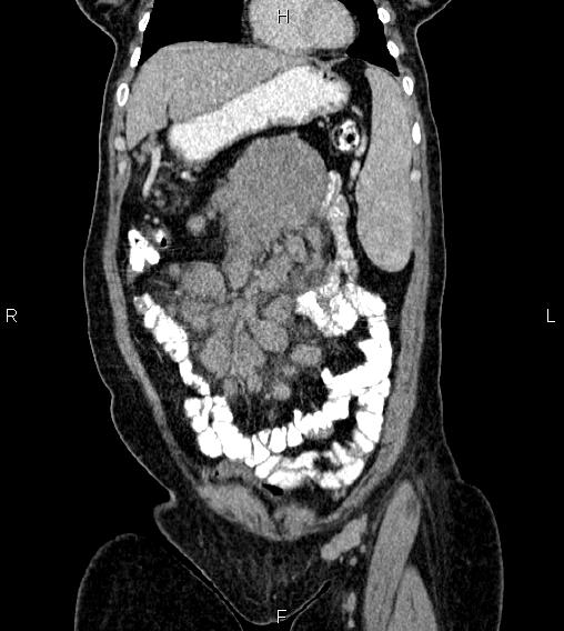 Abdominal lymphoma with sandwich sign (Radiopaedia 84378-99704 Coronal C+ portal venous phase 11).jpg