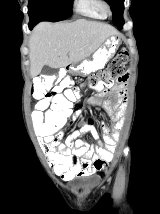 Abdominal wall and retroperitoneal tuberculosis (Radiopaedia 88137-104729 Coronal C+ portal venous phase 25).jpg