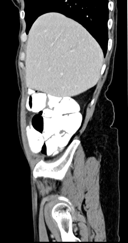 Abdominal wall and retroperitoneal tuberculosis (Radiopaedia 88137-104729 Sagittal C+ portal venous phase 122).jpg