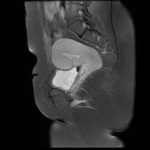 File:Abdominal wall endometriosis (Radiopaedia 83702-98847 Sagittal T1 C+ fat sat 11).jpg