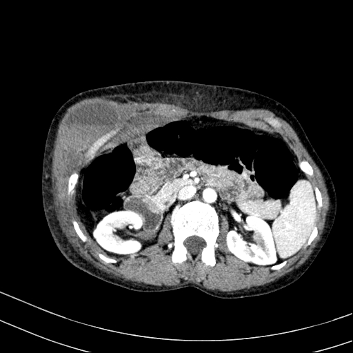 Abdominal wall hematoma with active bleeding (Radiopaedia 83915-99117 Axial renal cortical phase 23).jpg