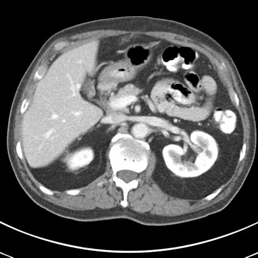 Abdominal wall metastasis from colorectal carcinoma (Radiopaedia 31016-31717 Axial C+ portal venous phase 25).jpg
