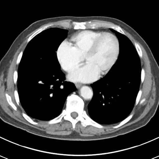 Abdominal wall metastasis from colorectal carcinoma (Radiopaedia 31016-31717 Axial C+ portal venous phase 4).jpg
