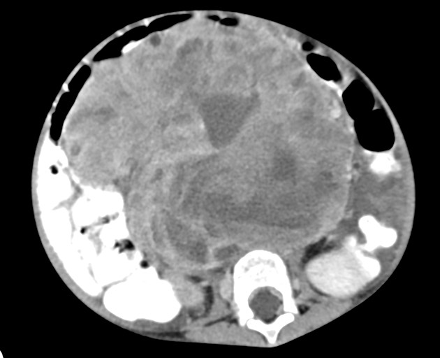 Abdominopelvic rhabdomyosarcoma (Radiopaedia 78356-90984 Axial C+ portal venous phase 98).jpg