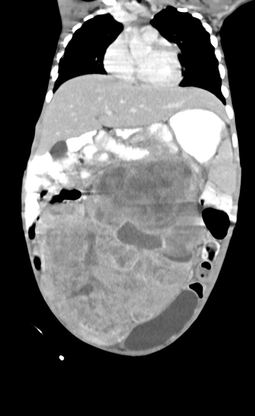 Abdominopelvic rhabdomyosarcoma (Radiopaedia 78356-90984 Coronal C+ portal venous phase 34).jpg