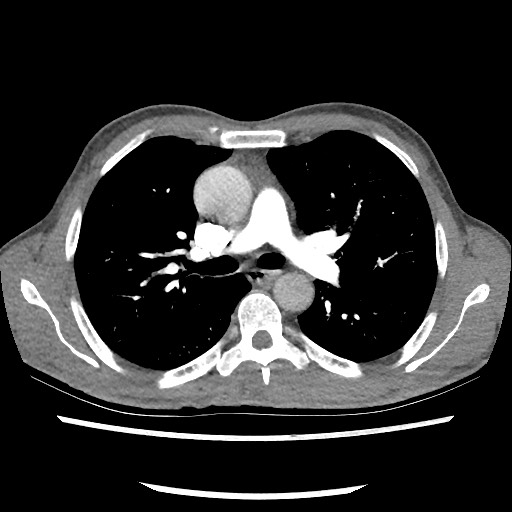 Accessory left horizontal fissure with lingular pneumonia (Radiopaedia 53763-59843 Axial C+ CTPA 41).jpg