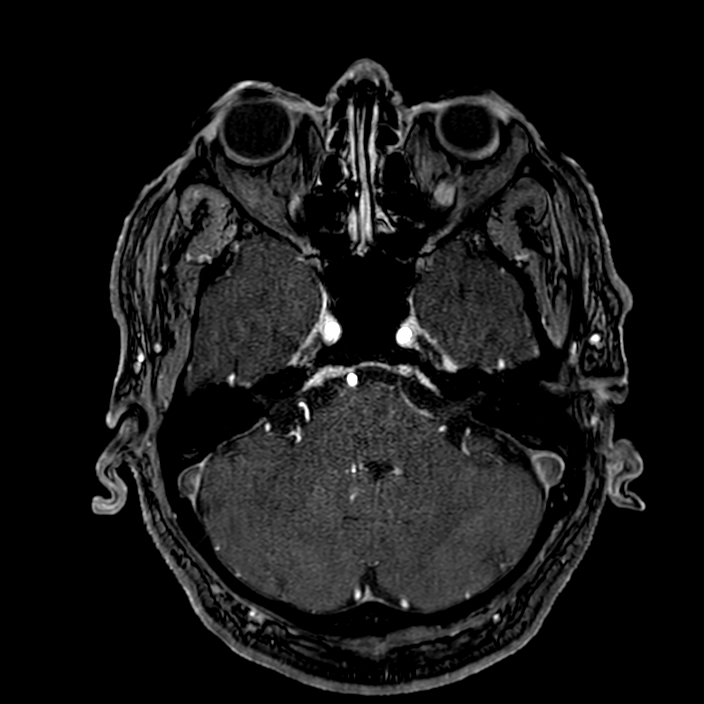 Accessory middle cerebral artery (Radiopaedia 73114-83828 Axial MRA 38).jpg