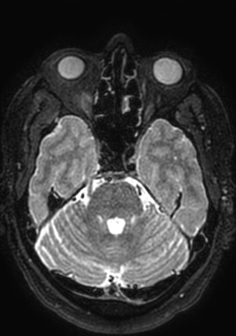Accessory middle cerebral artery (Radiopaedia 73114-83828 Axial T2 148).jpg