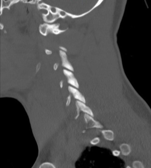 File:Accessory ossicle of the anterior arch of C1 vertebra (Radiopaedia 58149-65211 Sagittal bone window 1).jpg