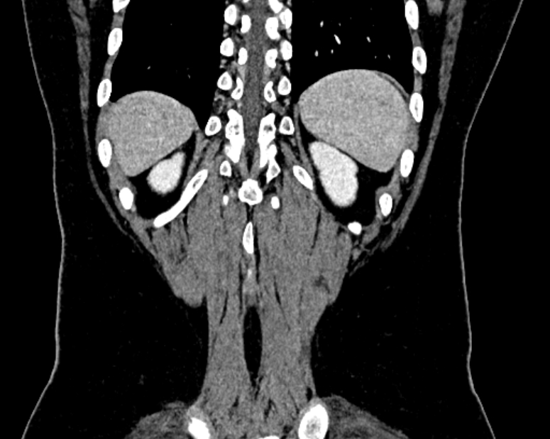 Accessory right inferior hepatic vein (Radiopaedia 75207-86305 Coronal C+ portal venous phase 72).jpg