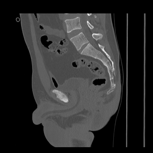 Acetabular and ilial fractures (Radiopaedia 59084-66378 Sagittal bone window 51).jpg