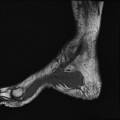 File:Achilles tendon tear (Radiopaedia 77615-89819 Sagittal T1 2).jpg