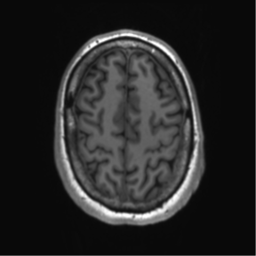 File:Achondroplasia (Radiopaedia 65109-74105 Axial T1 10).png