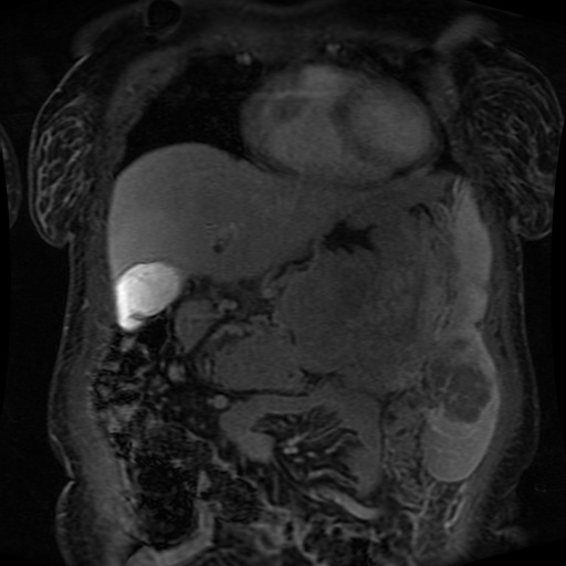Acinar cell carcinoma of the pancreas (Radiopaedia 75442-86668 Coronal T1 C+ fat sat 138).jpg
