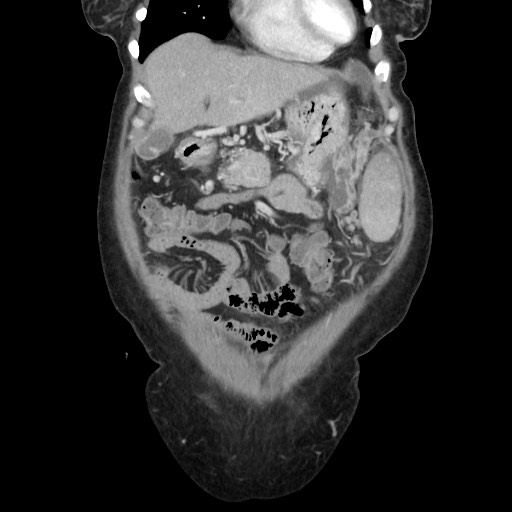 Acinar cell carcinoma of the pancreas (Radiopaedia 75442-86669 Coronal C+ portal venous phase 30).jpg