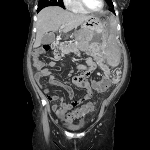 Acinar cell carcinoma of the pancreas (Radiopaedia 75442-86669 Coronal C+ portal venous phase 42).jpg
