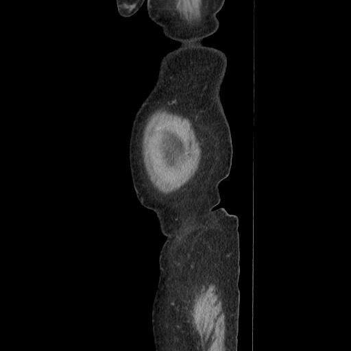 File:Acinar cell carcinoma of the pancreas (Radiopaedia 75442-86669 Sagittal C+ portal venous phase 22).jpg