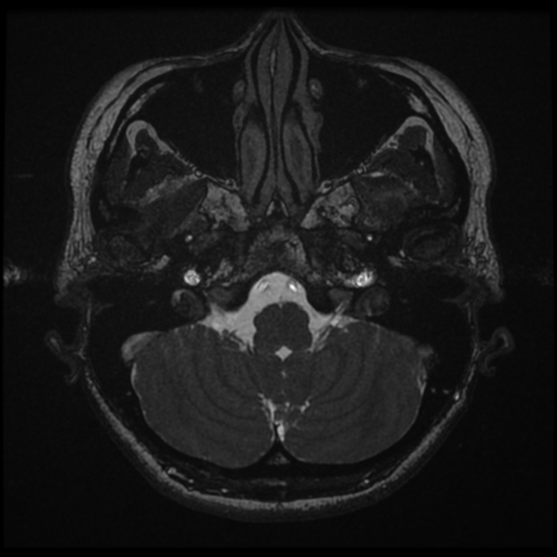 Acoustic neuroma (Radiopaedia 34049-35283 Axial 26).png