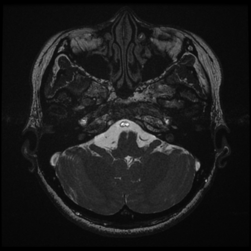 Acoustic neuroma (Radiopaedia 34049-35283 Axial 38).png
