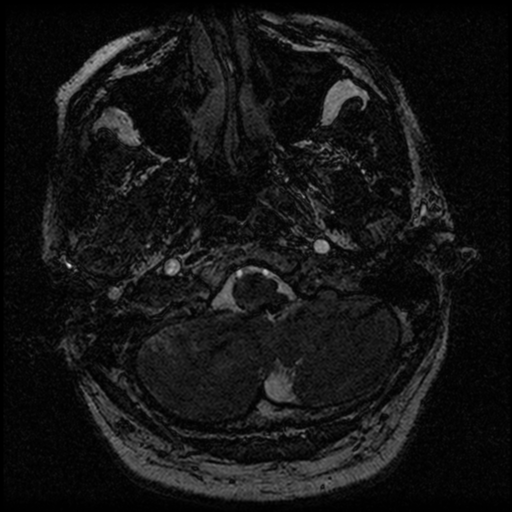 File:Acoustic schwannoma (Radiopaedia 39170-41387 Axial FIESTA 23).png