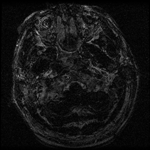 File:Acoustic schwannoma (Radiopaedia 39170-41387 Axial FIESTA 4).png