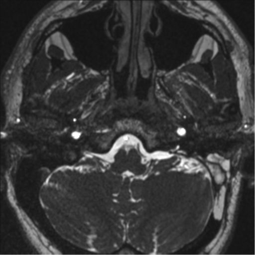 Acoustic schwannoma (translabyrinthine resection) (Radiopaedia 43570-46972 Axial CISS 14).png