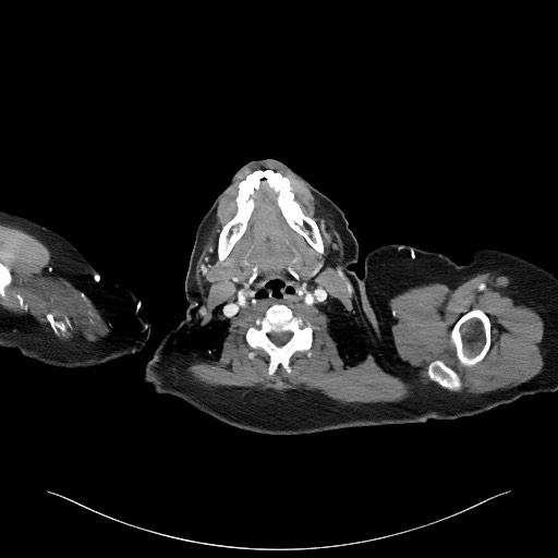 Acromioclavicular joint cyst (Radiopaedia 58455-65610 Axial C+ arterial phase 3).jpg