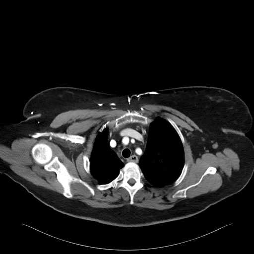 Acromioclavicular joint cyst (Radiopaedia 58455-65610 Axial C+ arterial phase 33).jpg