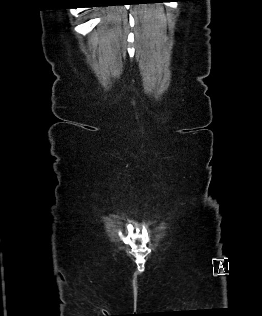 Active Crohn disease (Radiopaedia 59394-66750 Coronal C+ portal venous phase 66).jpg