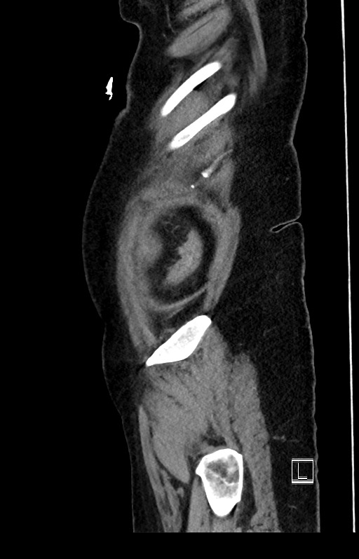 Active Crohn disease (Radiopaedia 59394-66750 Sagittal C+ portal venous phase 6).jpg