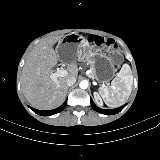 Active crohn disease (Radiopaedia 87133-103397 Axial C+ arterial phase 28).jpg