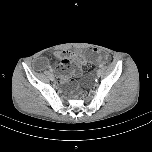 Active crohn disease (Radiopaedia 87133-103397 Axial C+ delayed 60).jpg