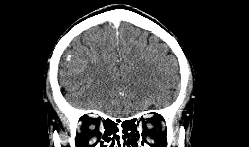 File:Active neurocysticercosis before and after therapy (Radiopaedia 71710-82099 Coronal C+ delayed 24).jpg