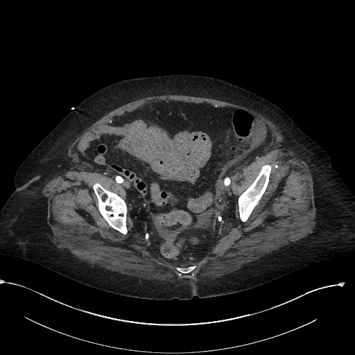 Active renal extravasation with large subcapsular and retroperitoneal hemorrhage (Radiopaedia 60975-68796 Axial C+ arterial phase 167).jpg