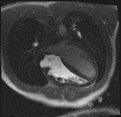 Active right ventricular cardiac sarcoidosis (Radiopaedia 55596-62100 Axial Dynamic perfusion scan MOCO 54).jpg