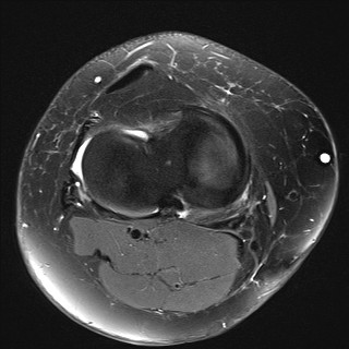 File:Acute-on-chronic transient lateral patellar dislocation with trochlear dysplasia (Radiopaedia 84099-99349 Axial PD fat sat 24).jpg