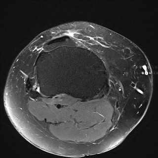 File:Acute-on-chronic transient lateral patellar dislocation with trochlear dysplasia (Radiopaedia 84099-99349 Axial PD fat sat 28).jpg
