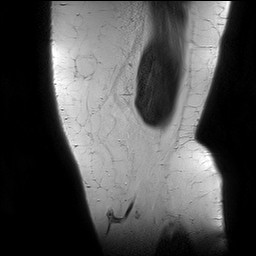 Acute-on-chronic transient lateral patellar dislocation with trochlear dysplasia (Radiopaedia 84099-99349 Sagittal PD 9).jpg