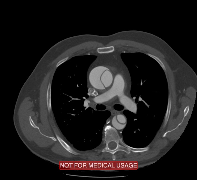Acute aortic dissection - Stanford type A (Radiopaedia 40661-43285 Axial C+ arterial phase 22).jpg
