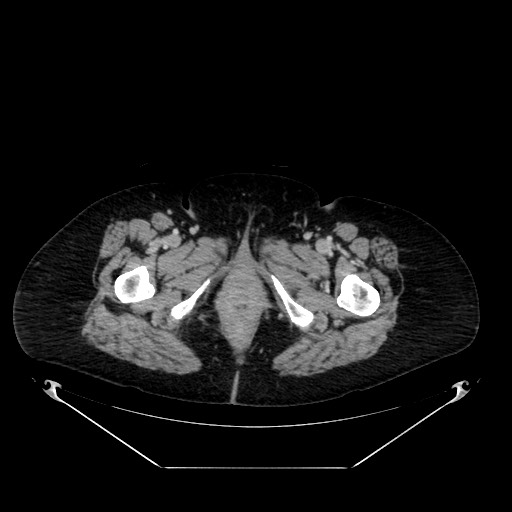 Acute appendicitis, heterotaxy syndrome (Radiopaedia 66884-76202 Axial C+ portal venous phase 139).jpg