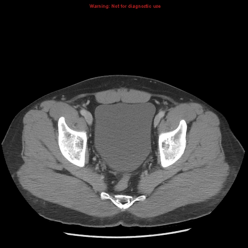 Acute appendicitis (Radiopaedia 10498-10973 Axial C+ portal venous phase 54).jpg